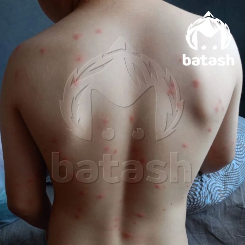 Зудящие волдыри вылезли на телах уфимцев после купания в Кашкадане